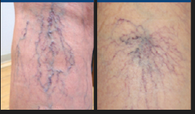 細絡（さいらく）は治療すべき？